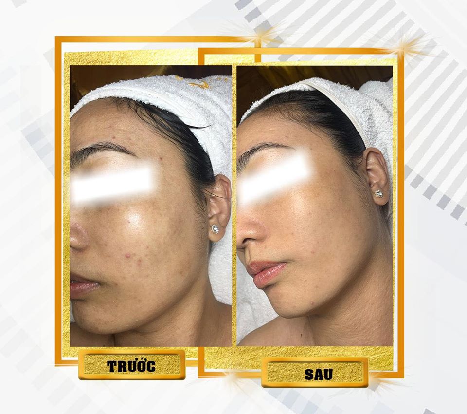 Điều trị nám da mặt tại Thu Minh Beauty - hiệu quả 99%